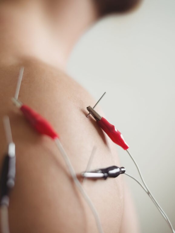 Close-up of patient getting electro dry needling on shoulder