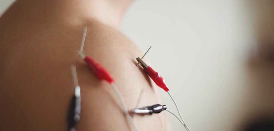 Close-up of patient getting electro dry needling on shoulder Close-up of patient getting electro dry needling on shoulder
