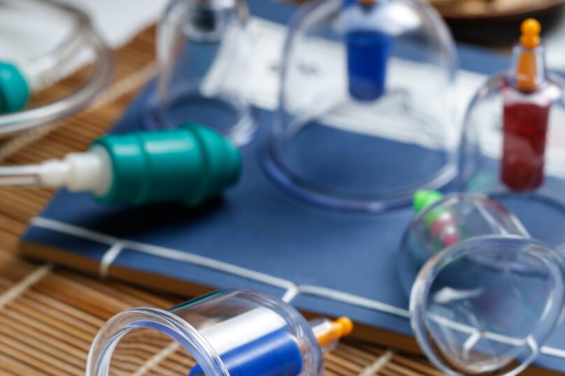 Cupping therapy of traditional Chinese medicine Cupping therapy of traditional Chinese medicine