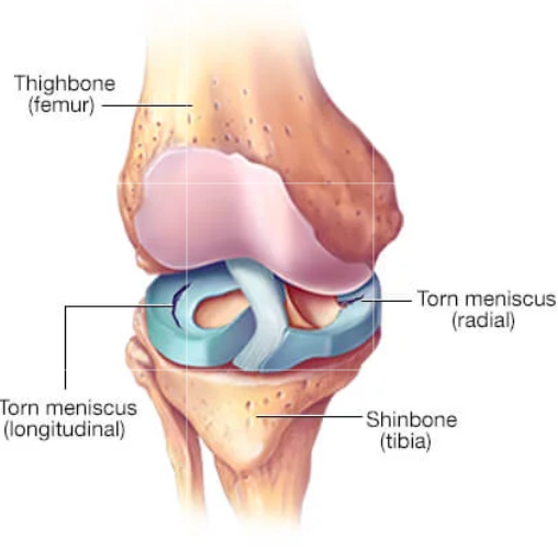 Meniscus Tear Physiotherapy-AR clinics
