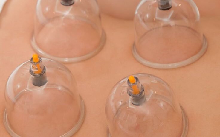 About us _ Best Hijama Clinic in Chennai _ Cupping at Halina Clinic