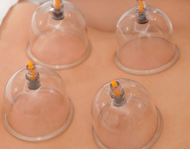 About us _ Best Hijama Clinic in Chennai _ Cupping at Halina Clinic
